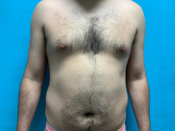 Liposuction Case 11 - Before