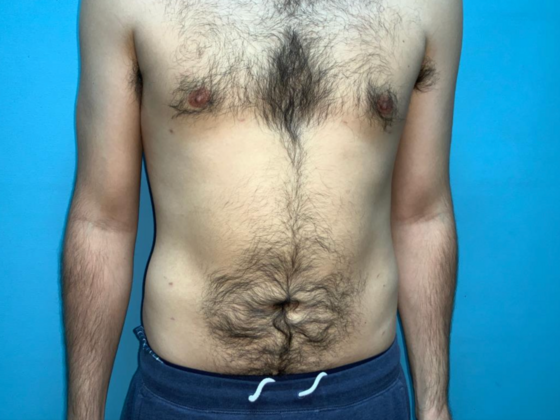 Liposuction Case 11 - After