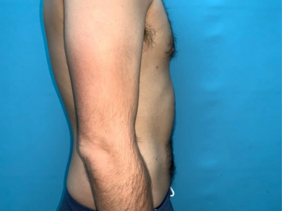 Liposuction: Case 11 - After