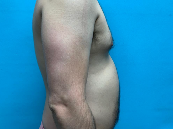 Liposuction: Case 11 - Before