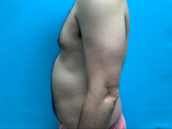 Liposuction: Case 11 - Before