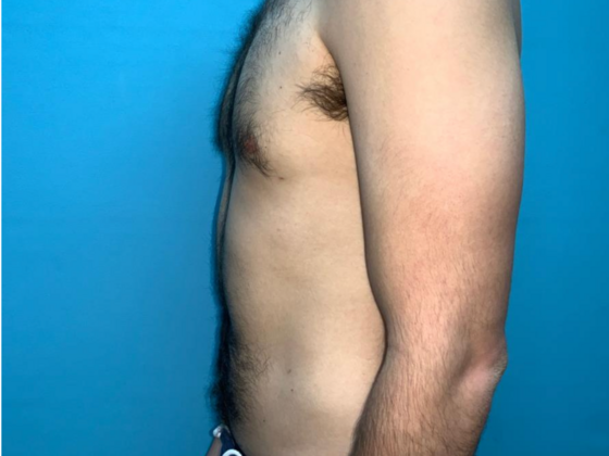 Liposuction: Case 11 - After