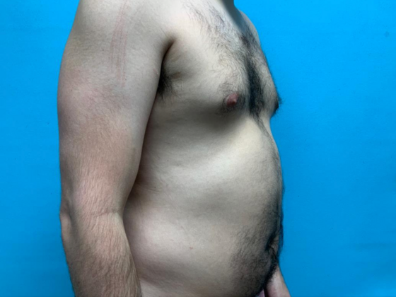 Liposuction: Case 11 - Before