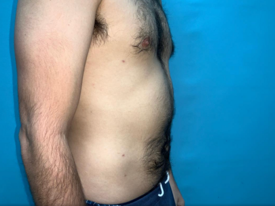 Liposuction: Case 11 - After