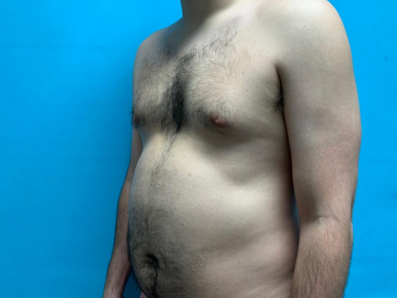 Liposuction: Case 11 - Before