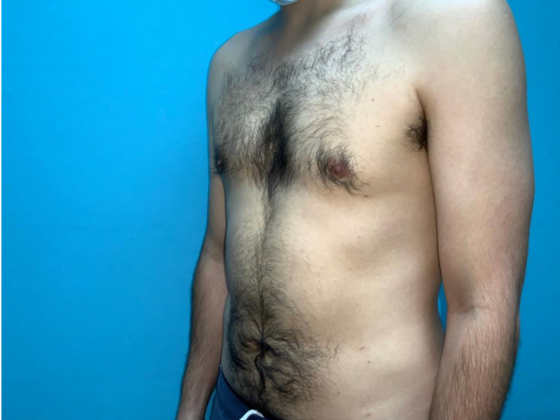 Liposuction: Case 11 - After