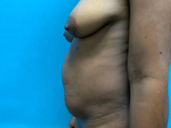 Tummy Tuck: Case 4 - Before