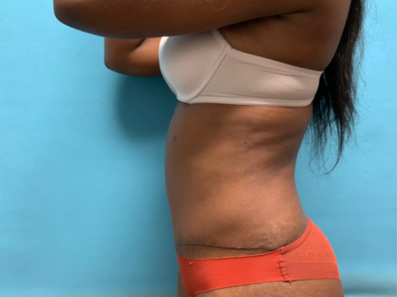 Tummy Tuck: Case 4 - After