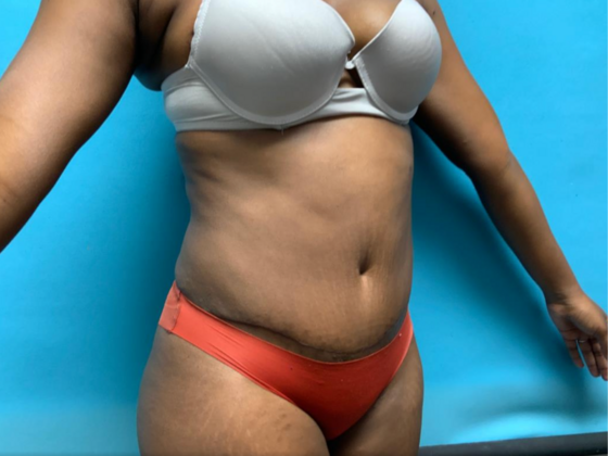Tummy Tuck: Case 4 - After