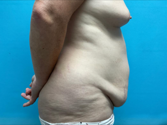 Mommy Makeover: Case 28 - Before