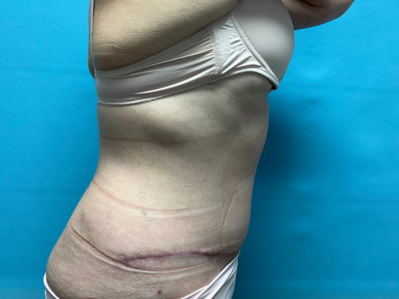 Mommy Makeover: Case 28 - After