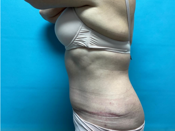 Mommy Makeover: Case 28 - After