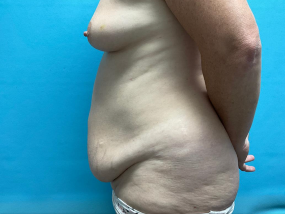 Mommy Makeover: Case 28 - Before