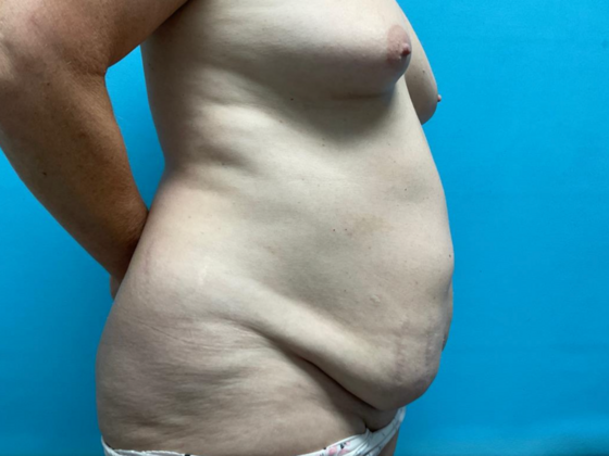 Mommy Makeover: Case 28 - Before