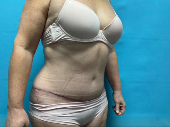 Mommy Makeover: Case 28 - After