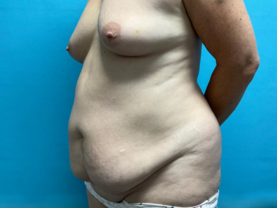 Mommy Makeover: Case 28 - Before