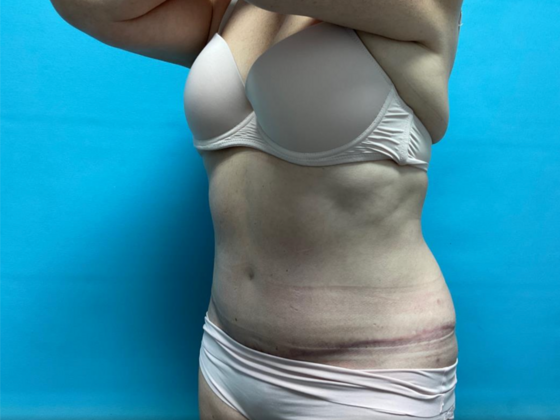 Mommy Makeover: Case 28 - After