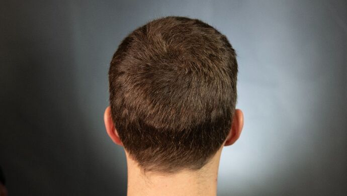 FUT Hair Restoration: Case 17 - Before