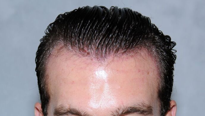 FUT Hair Restoration: Case 17 - Before