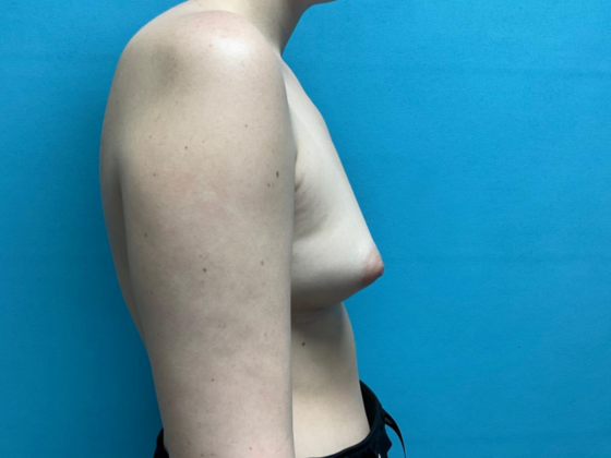 Breast Augmentation: Case 26 - Before