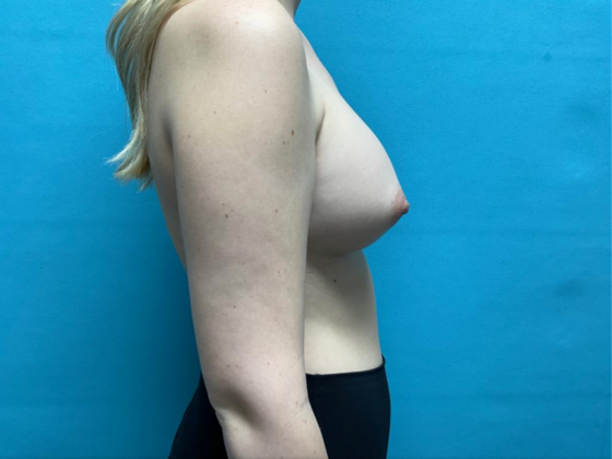 Breast Augmentation: Case 26 - After