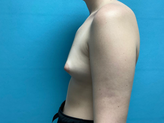 Breast Augmentation: Case 26 - Before