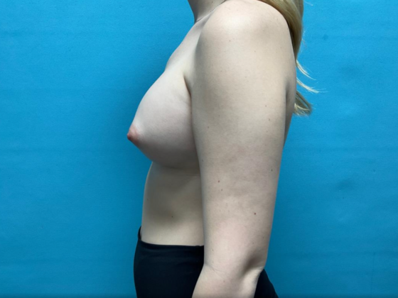 Breast Augmentation: Case 26 - After