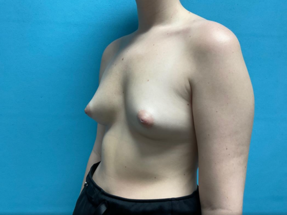 Breast Augmentation: Case 26 - Before