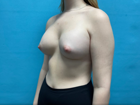 Breast Augmentation: Case 26 - After