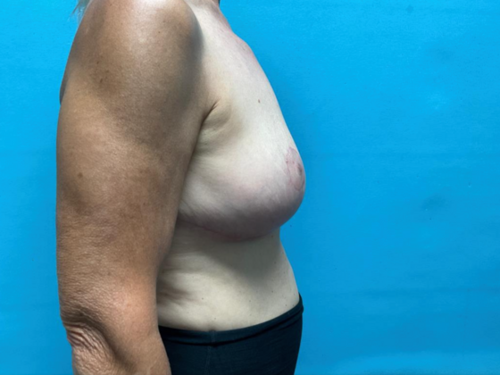Breast Lift: Case 11 - After