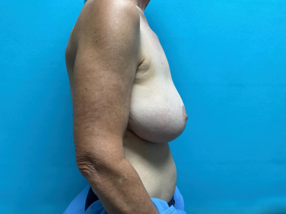 Breast Lift: Case 11 - Before