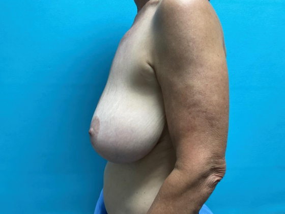 Breast Lift: Case 11 - Before