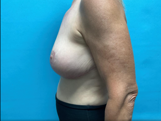 Breast Lift: Case 11 - After