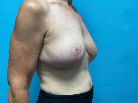 Breast Lift: Case 11 - After