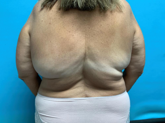 Liposuction Case 12 - Before