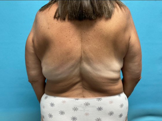 Liposuction Case 12 - After