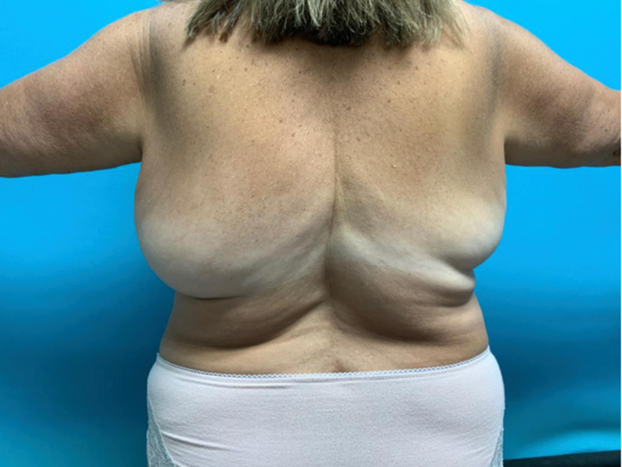 Liposuction: Case 12 - Before