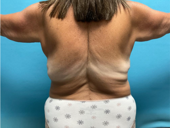 Liposuction: Case 12 - After