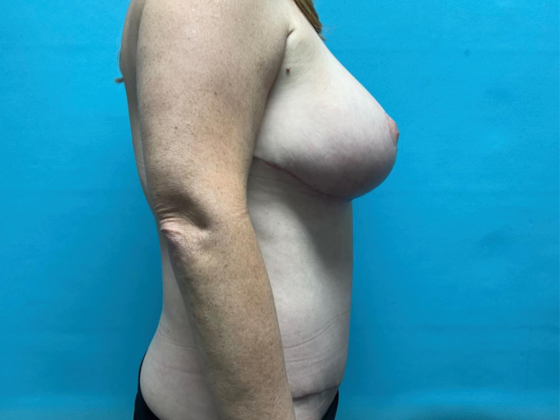 Tummy Tuck: Case 5 - After