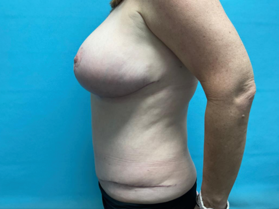 Tummy Tuck: Case 5 - After