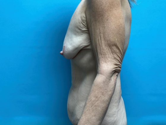 Tummy Tuck: Case 6 - Before