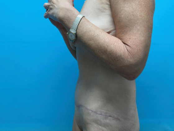 Tummy Tuck: Case 6 - After