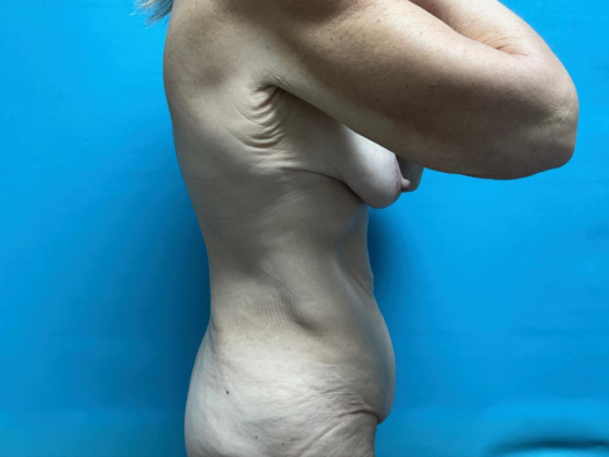 Tummy Tuck: Case 6 - Before