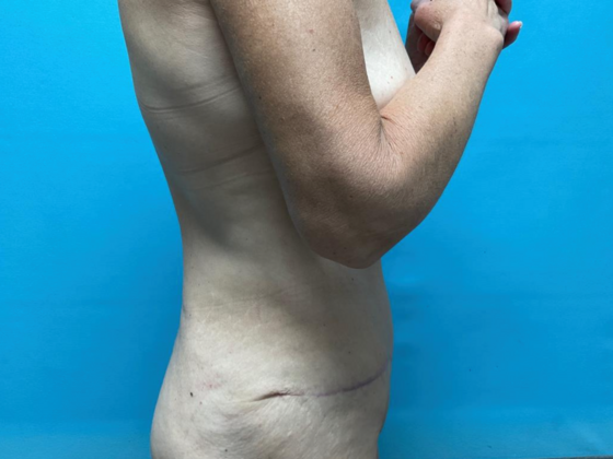 Tummy Tuck: Case 6 - After