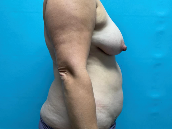 Liposuction: Case 13 - Before