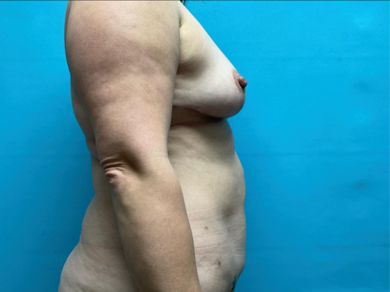 Liposuction: Case 13 - After