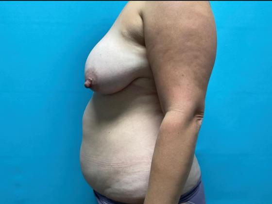 Liposuction: Case 13 - Before
