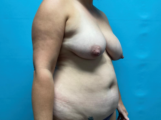 Liposuction: Case 13 - Before