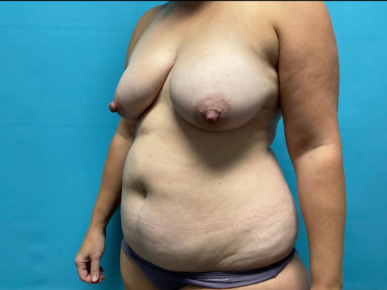 Liposuction: Case 13 - Before