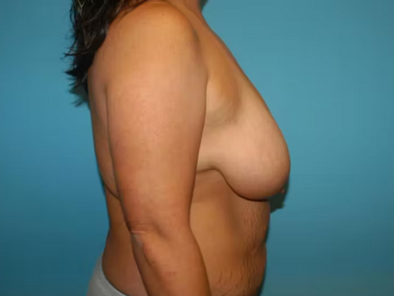 Mommy Makeover: Case 31 - Before